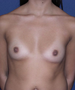 Breast Augmentation Patient 89770 Photo 1