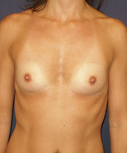 Breast Augmentation Patient 15787 Photo 1