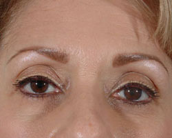 Blepharoplasty Patient 53831 After Photo # 2
