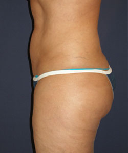 Liposuction Patient 10146 Photo 5