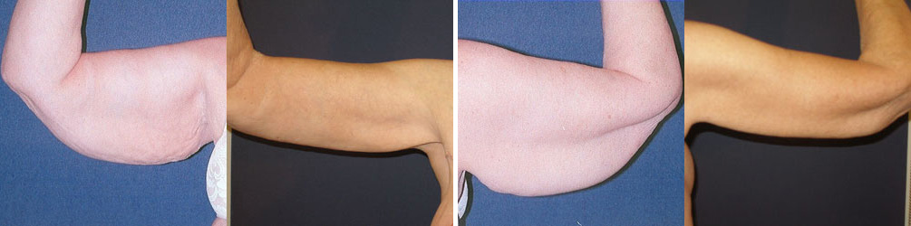 Before and After Image: Patient # 10022 - front