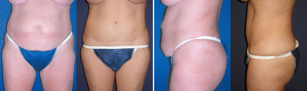 Before and After Image: Patient # 11649 - other