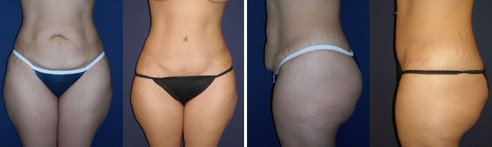 Before and After Image: Patient # 25869 - other