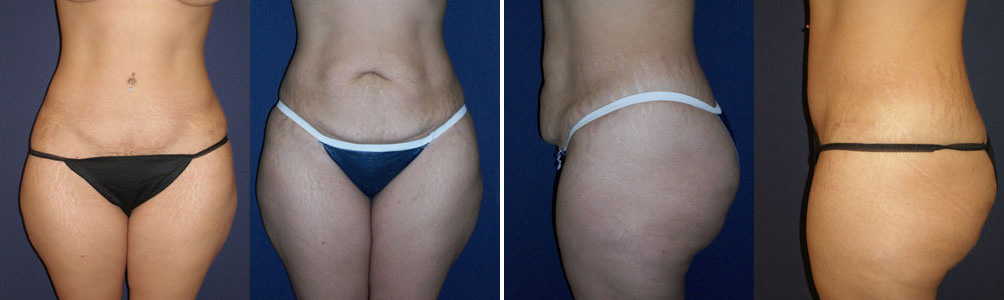 Before and After Image: Patient # 25869 - other