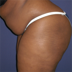 Abdominoplasty (Tummy Tuck) Patient 30895 Photo 3
