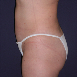 Liposuction Patient 53341 Photo 4