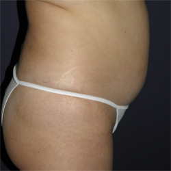 Liposuction Patient 53341 Photo 3