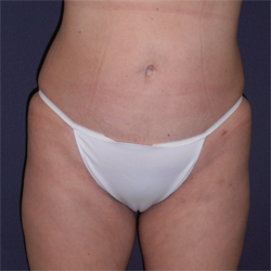 Liposuction Patient 53341 After Photo # 2
