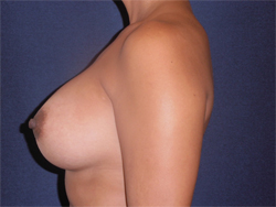 Breast Augmentation Patient 72298 Photo 4