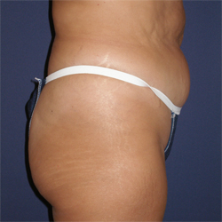 Abdominoplasty (Tummy Tuck) Patient 88088 Photo 3