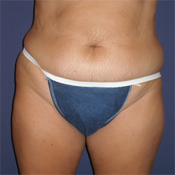 Abdominoplasty (Tummy Tuck) Patient 88088 Before Photo # 1