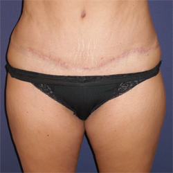 Abdominoplasty (Tummy Tuck) Patient 88088 Photo 2