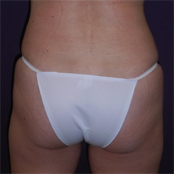 Liposuction Patient 53341 Photo 6