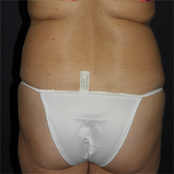 Liposuction Patient 53341 Photo 5