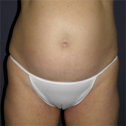 Liposuction Patient 53341 Before Photo # 1