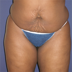 Abdominoplasty (Tummy Tuck) Patient 30895 Before Photo # 1