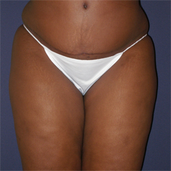 Abdominoplasty (Tummy Tuck) Patient 30895 After Photo # 2