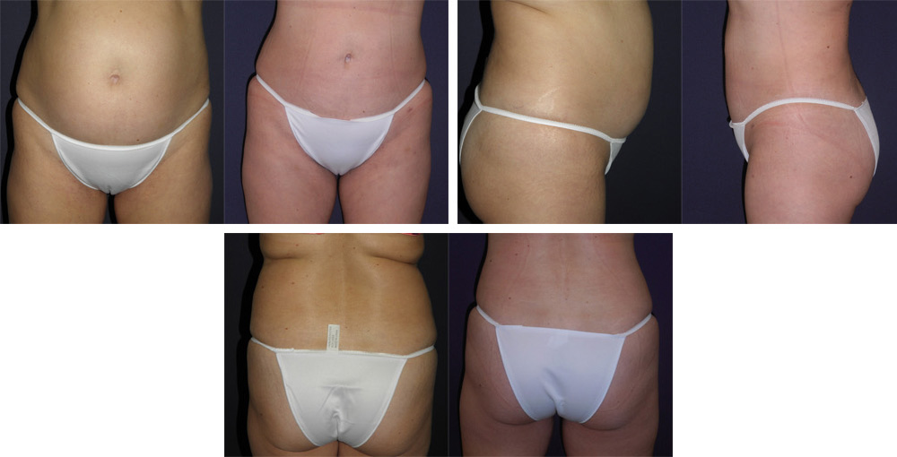 Before and After Image: Patient # 53341 - other