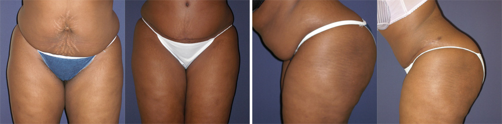 Before and After Image: Patient # 30895 - other