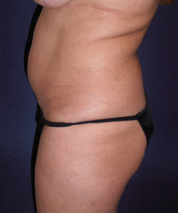 Liposuction Patient 23529 Photo 3