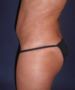 Liposuction Patient 23529 Photo 4