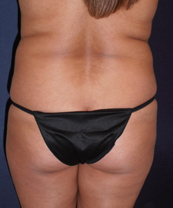 Liposuction Patient 23529 Before Photo # 1