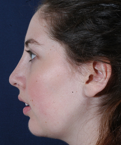 Rhionoplasty with Chin Implants Patient 83103 Photo 4