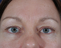 Blepharoplasty Patient 33404 Photo 3