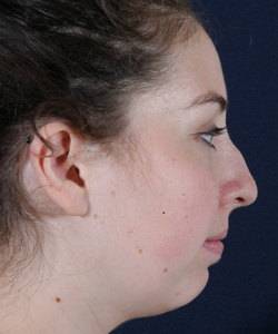 Rhionoplasty with Chin Implants Patient 83103 Photo 1