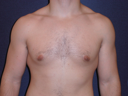 Gynecomastia Patient 45146 Photo 2