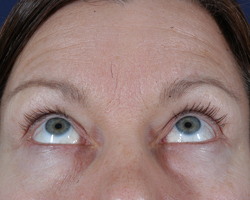 Blepharoplasty Patient 33404 Before Photo # 1