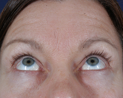 Blepharoplasty Patient 33404 Photo 1