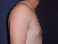 Gynecomastia Patient 48046 After Photo # 2