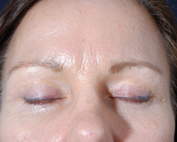 Blepharoplasty Patient 33404 After Photo # 2