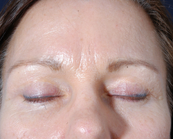 Blepharoplasty Patient 33404 Photo 2