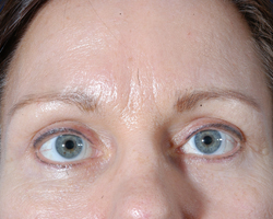 Blepharoplasty Patient 33404 Photo 4