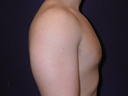 Gynecomastia Patient 45146 Photo 4