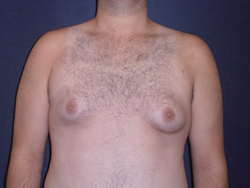 Gynecomastia Patient 19641 Before Photo # 1