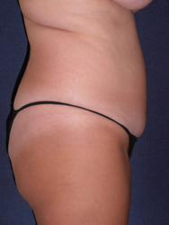 Liposuction Patient 61084 Photo 3