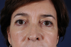 Blepharoplasty Patient 12634 Before Photo # 1