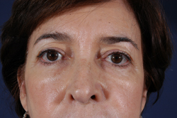 Blepharoplasty Patient 12634 Photo 1