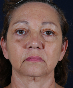 Facelift Patient 61744 Before Photo # 1