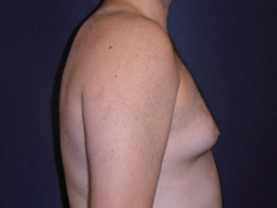 Gynecomastia Patient 19641 Photo 3