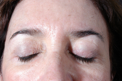 Blepharoplasty Patient 12634 Photo 4