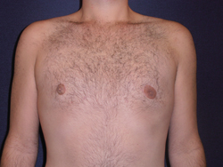 Gynecomastia Patient 19641 Photo 2