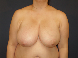 Breast Reduction Patient 43480 Before Photo # 1