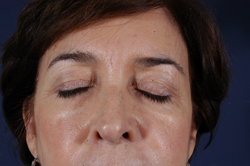 Blepharoplasty Patient 12634 Photo 3