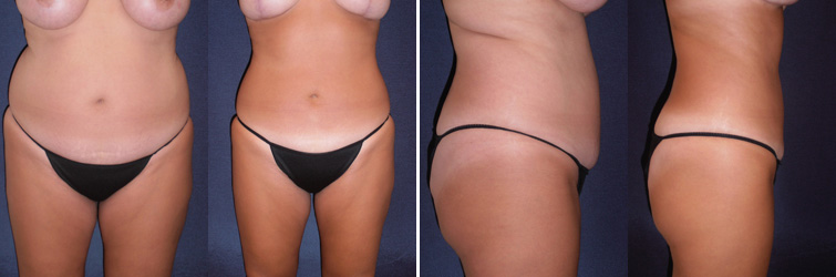 Before and After Image: Patient # 61084 - front