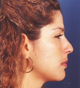 Rhinoplasty Patient 30919 Before Photo # 1