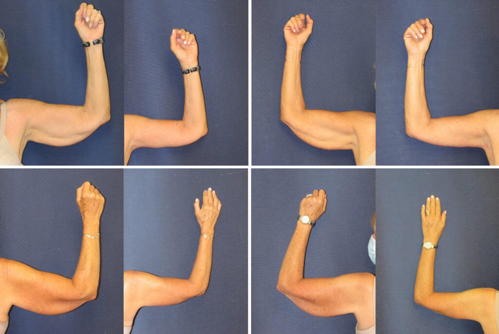 Before and After Image: Patient # 11772 - front